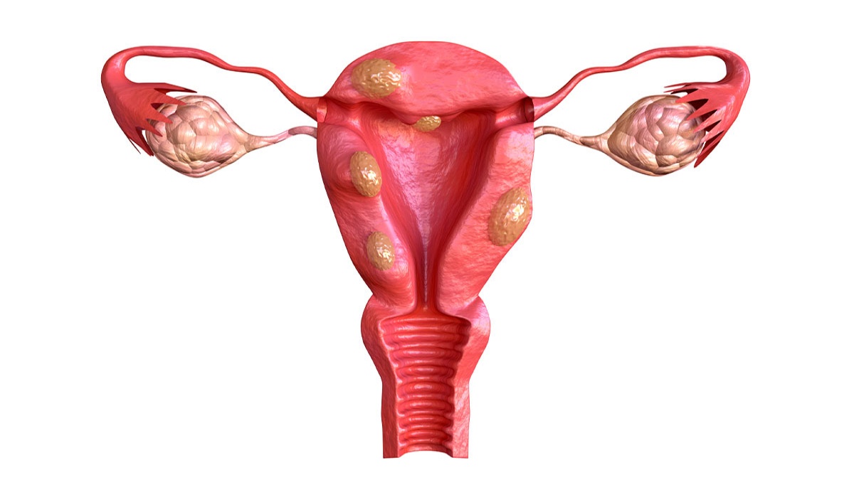 Mioma Uterino
